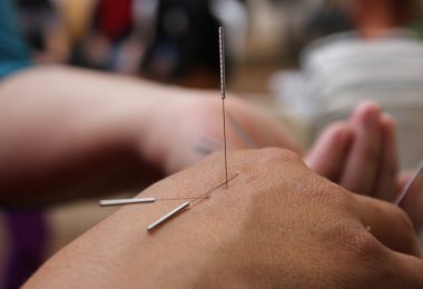 acupuncture effet au bout de combien de temps