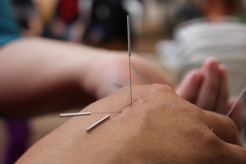 acupuncture effet au bout de combien de temps